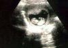 Jedanaesta nedelja trudnoće - šta se dešava sa bebom, fotografija fetusa, senzacije